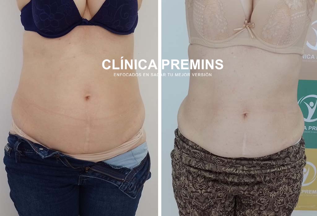 Hidrolipoclasia + tratamiento reafirmante - Imagen 3