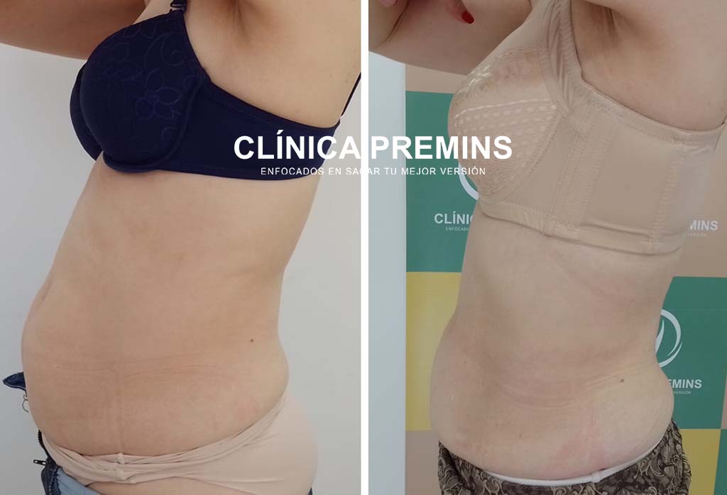 Hidrolipoclasia + tratamiento reafirmante - Imagen 4