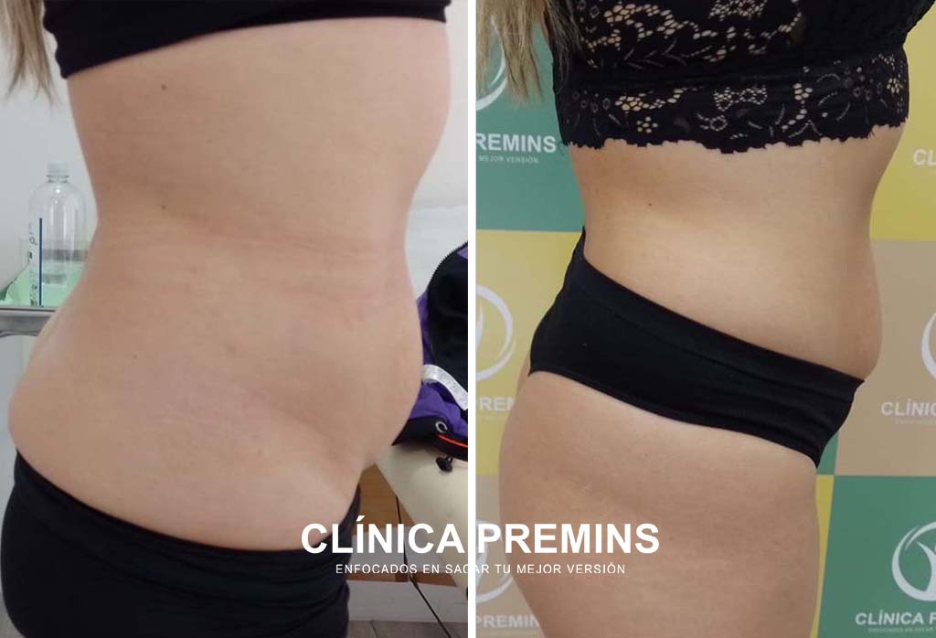 Hidrolipoclasia + tratamiento reafirmante - Imagen 2
