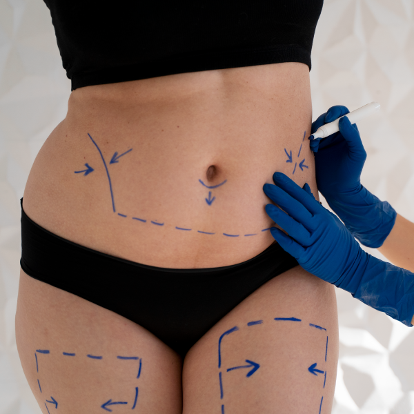 Minilipo Hidrolipoclasia 10 sesiones incluye tratamiento de control de peso